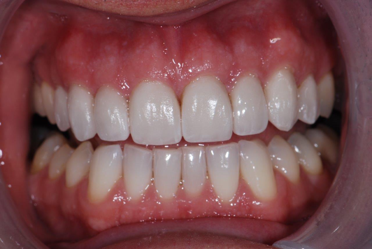 Eight Beautiful Porcelain Veneers