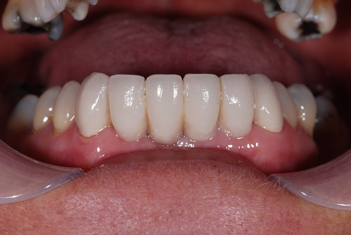 Dental Bridge Example on lower six teeth