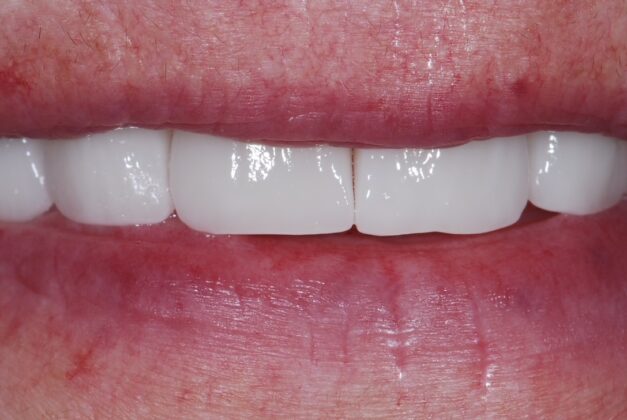 Veneers After