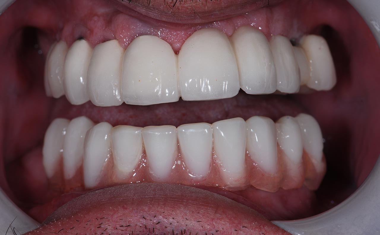 Dental Implants Example