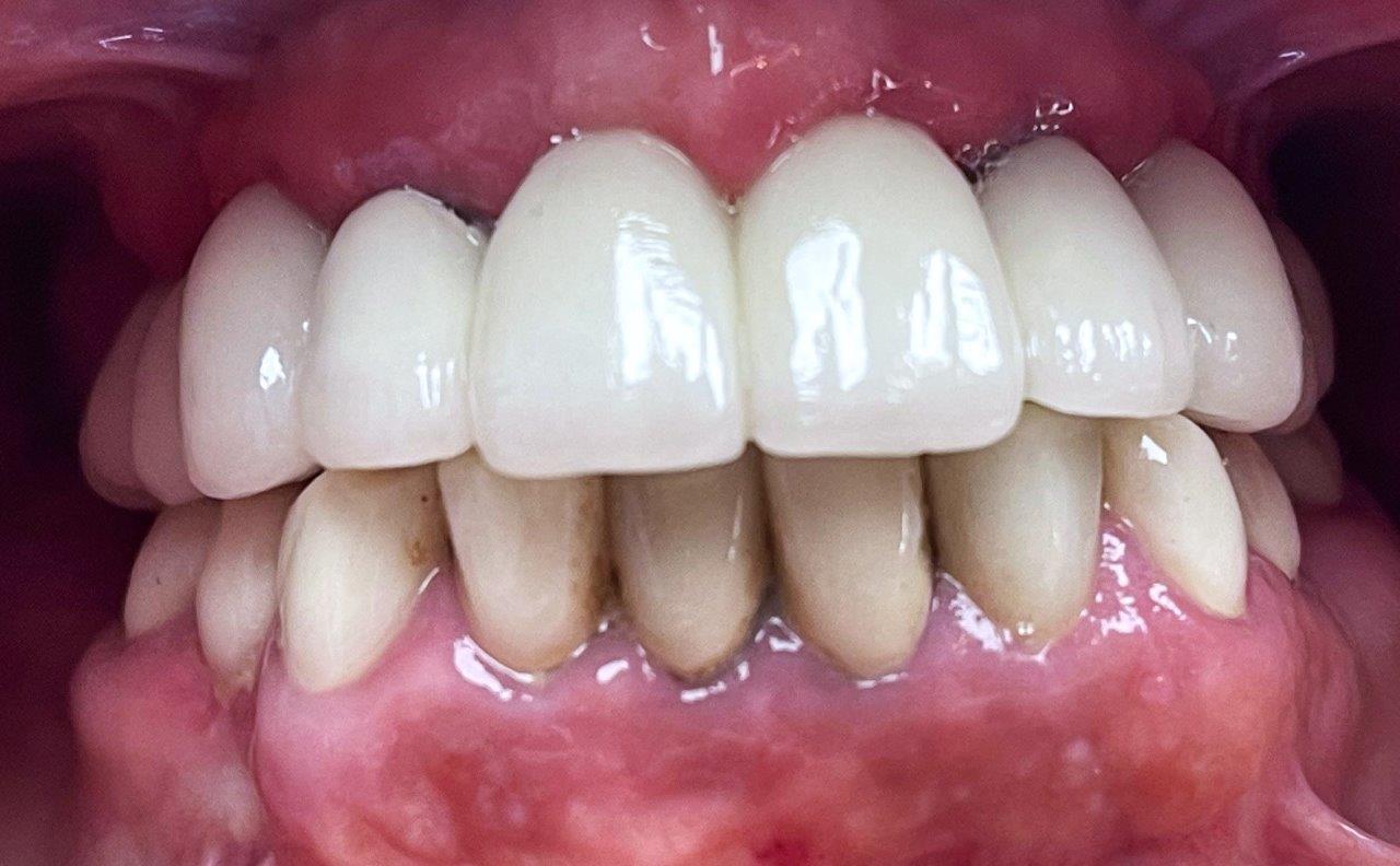 Example of Dental Implants